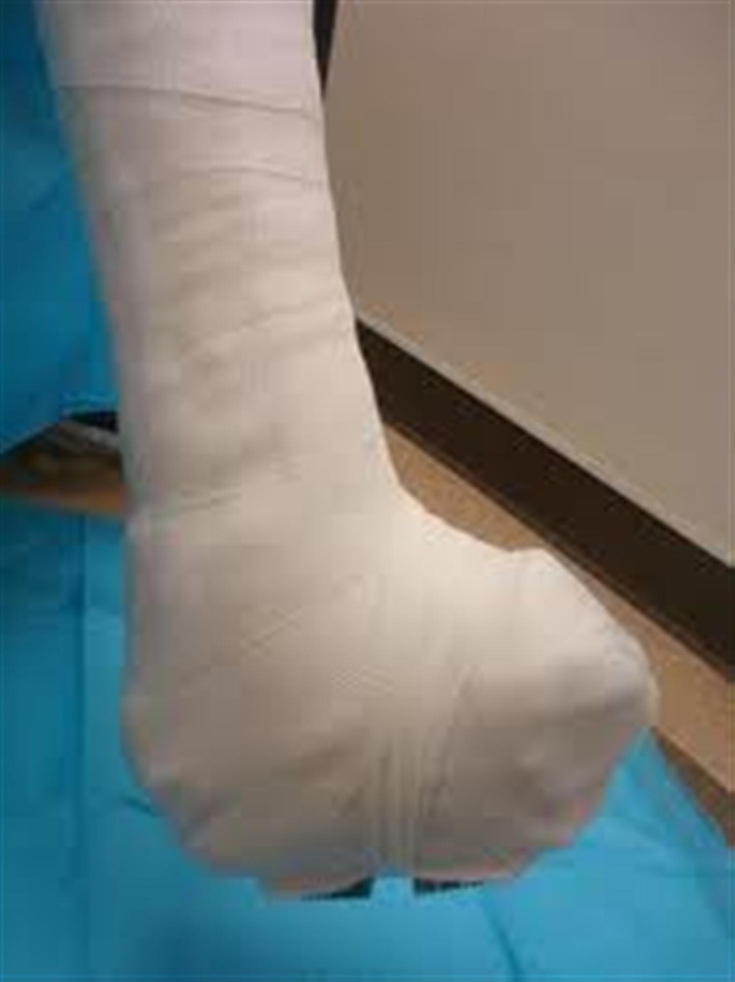 Diabetic Charcot Neuropathy Foot & Ankle Orthobullets